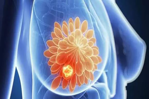 乳腺纤维瘤会癌变吗 什么是乳腺纤维瘤？
